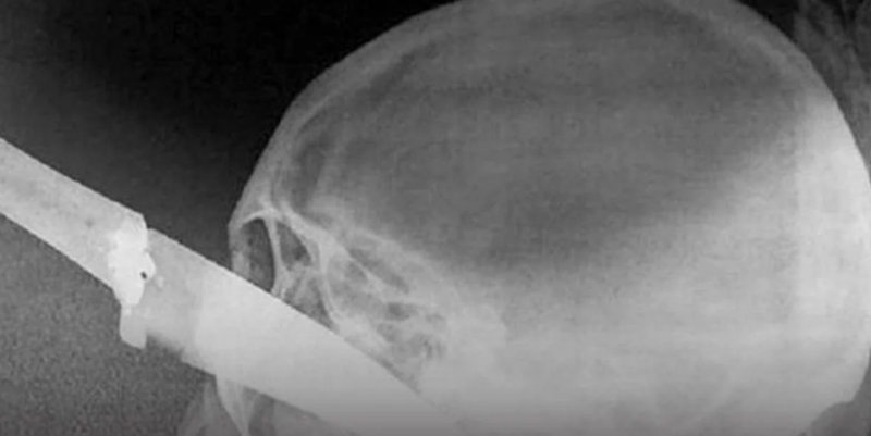 Brutal ataque en Salta: cuatro chicas le clavaron un cuchillo en el ojo a otra