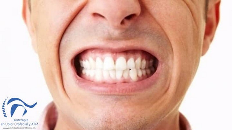 Bruxismo: conocé qué es y cómo crece por el estrés