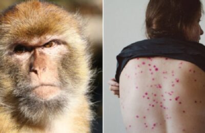 Confirmaron el segundo caso de viruela del mono en Argentina