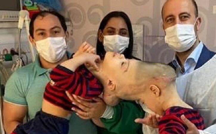 Exitosa cirugía que separó a siameses en Brasil será ofrecida gratis a otros niños de América Latina