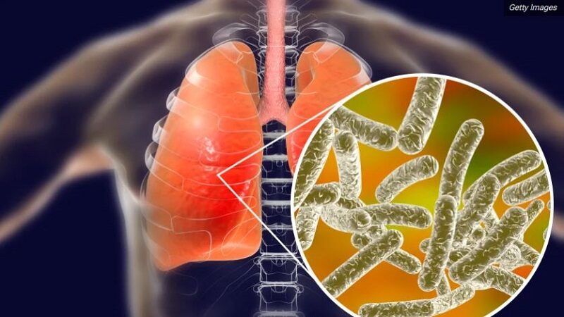 Ya son seis los muertos por Legionella en Tucumán: cuáles son los próximos pasos