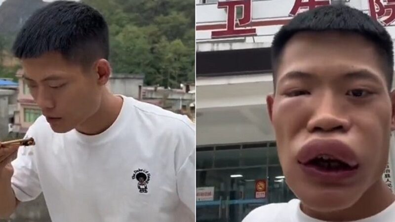 Desfigurado: así terminó un influencer tras comerse una avispa viva