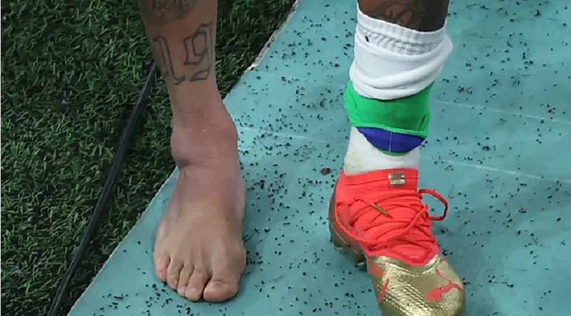 Impactante: así quedó el tobillo de Neymar tras la lesión que sufrió ante Serbia