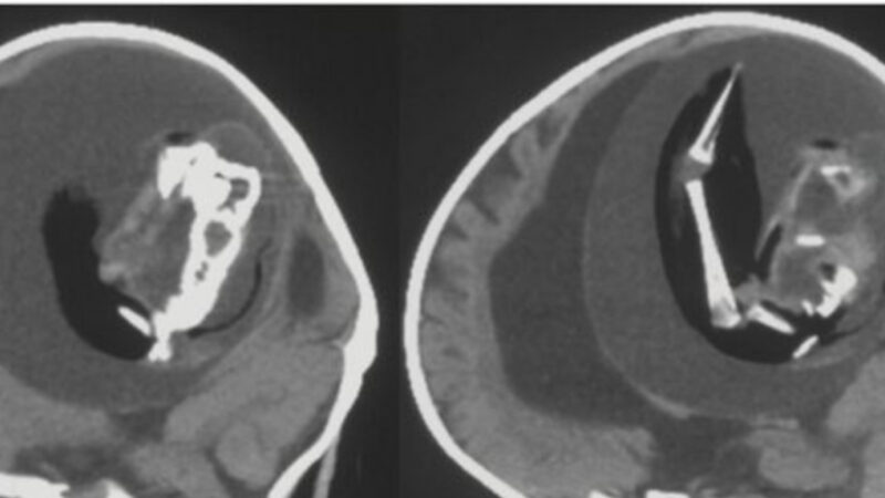 Extirpan del cerebro de una bebé de un año a su «gemelo parásito»
