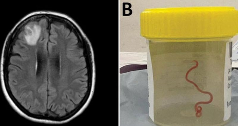 Investigadores encuentran por primera vez un gusano vivo en el cerebro de una mujer