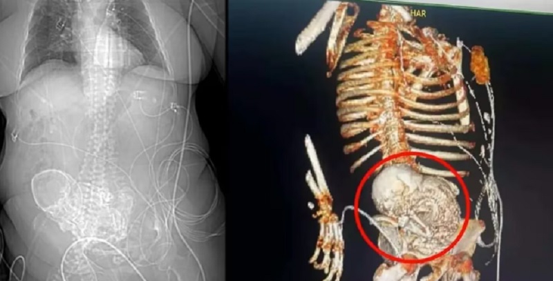 Una mujer murió después de que le extirparan el feto calcificado que tenía hace 30 años: “Un bebé de piedra”