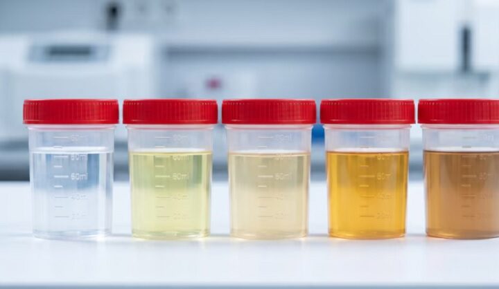 Qué dice el color de la orina sobre la salud y cuándo conviene consultar
