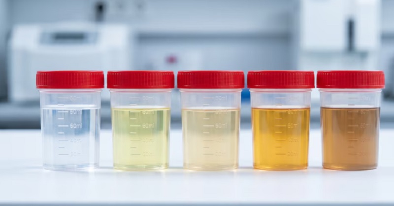 Qué dice el color de la orina sobre la salud y cuándo conviene consultar